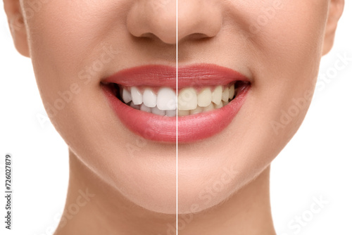 Woman showing teeth before and after whitening on white background, collage