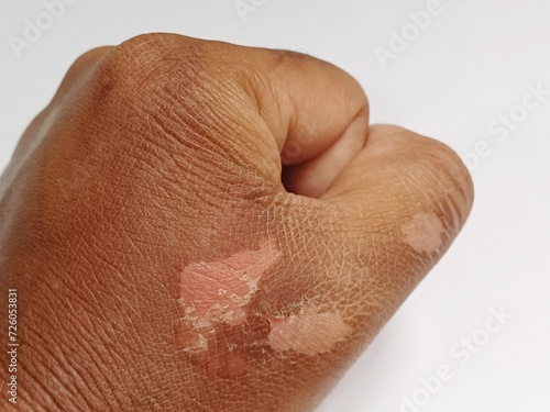 Male hand with scald scars  burn scars on the back of the hand