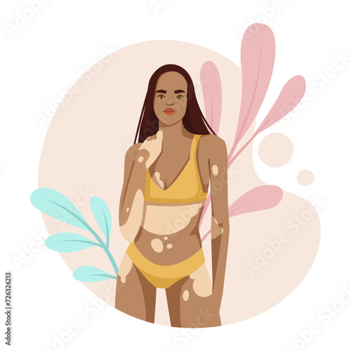 Young woman with pigmentation on skin. Girls body positive concept. Woman in swimsuit not shy about her body. Pigment spots dermatology desease. Flat vector illustration isolated on white background