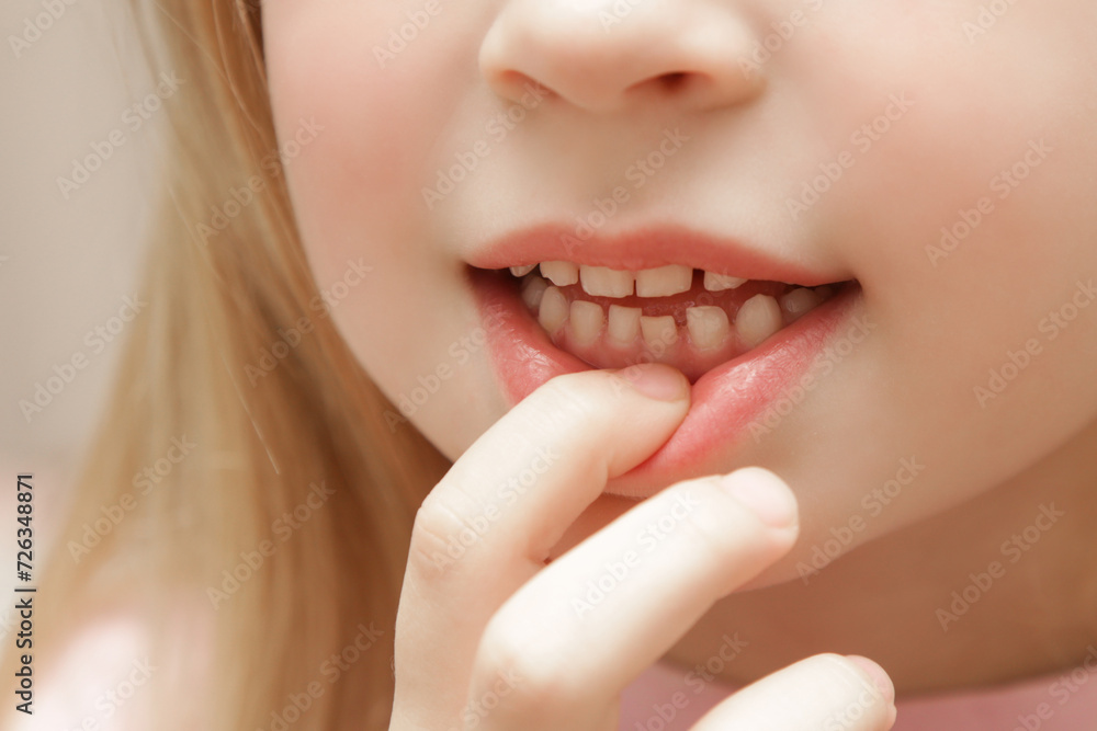 Fototapeta premium Cute preschool girl showing a loose primary (baby) tooth 