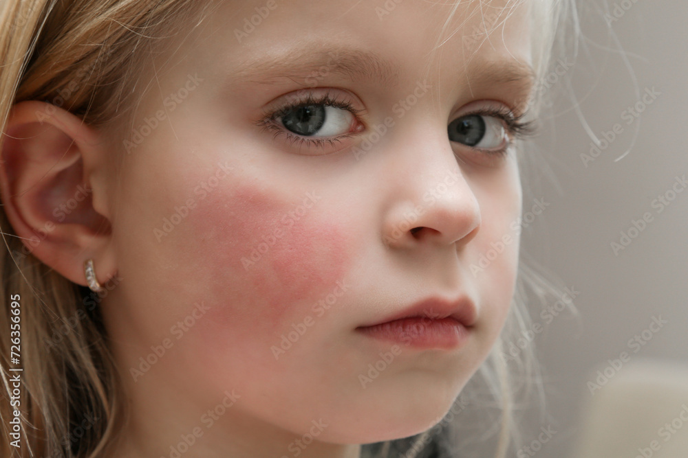 redness-on-child-s-cheeks-caused-by-eczema-dry-skin-or-allergy-stock