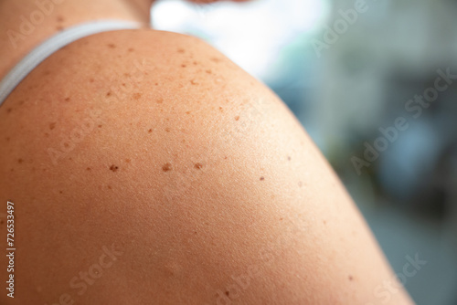 Skin Chronicles: A Woman's Shoulder Tales. Close-up image shows the details of a woman's shoulder seen from behind, adorned with nevi, ephelides, and freckles. Concept of skin care and sun protection