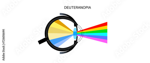 Deuteranomaly and deuteranopia