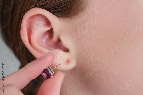 The teenager tore off his earlobe with an earring. The wound on the ear. photo