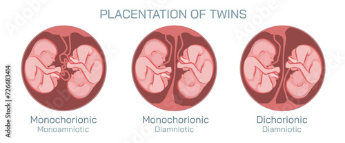 Ovulation, conception and implantation vector illustration. Anatomical diagram of fertilization and human reproductive process. Students learning and education study materials.