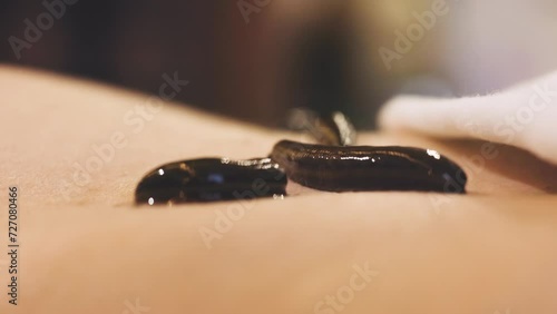 Close-up shot of medical leech on human body skin drinking blood, traditional medicine, hirudotherapy. Treatment with leeches and bloodletting. Freshwater worm. alternative treatment health concept 4k