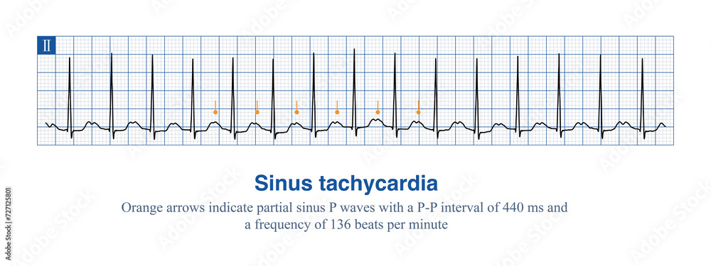 The frequency of sinus impulses exceeds 100 beats per minute, and the ...