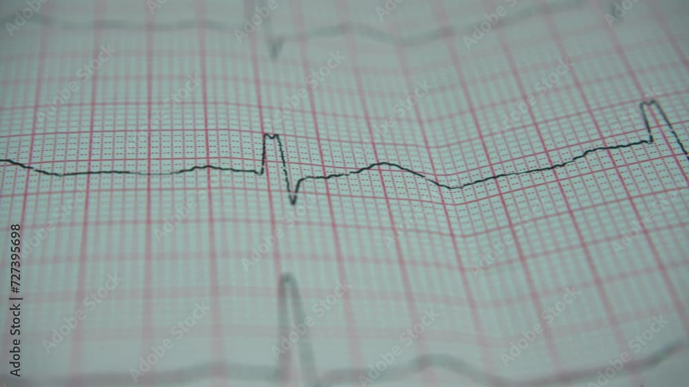 Close up of electrocardiogram in paper form. Diagonics, prevention and treatment of cardiovascular diseases.