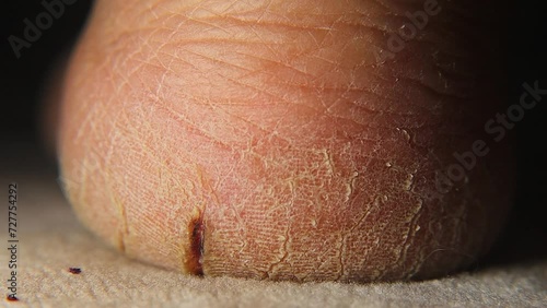 Heel cracks. Close up of a skin cracks in man. Wound Healing, Pathology. Healthcare, Medicine. Health care
 photo