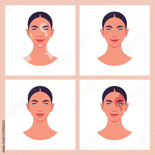 A set of female faces with vitiligo, birthmark, freckles and pigmentation. Portrait of teen on white background. Vector flat Illustration