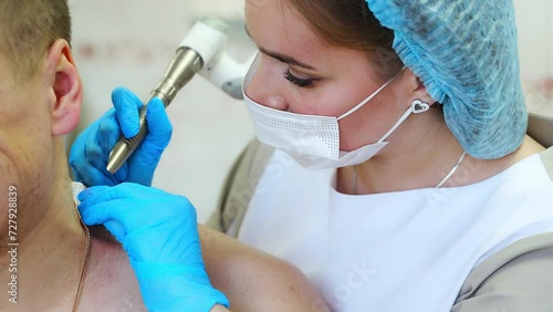 A dermatologist removes skin tumors with a laser, close up view of process of removing skin diseases photo