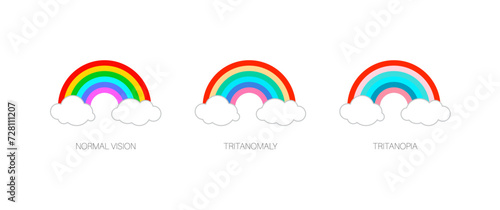 Tritanopia and tritanomaly