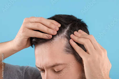 Man with dandruff in his dark hair on light blue background, closeup
