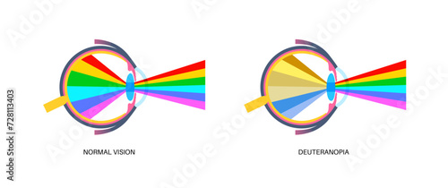 Deuteranomaly and deuteranopia