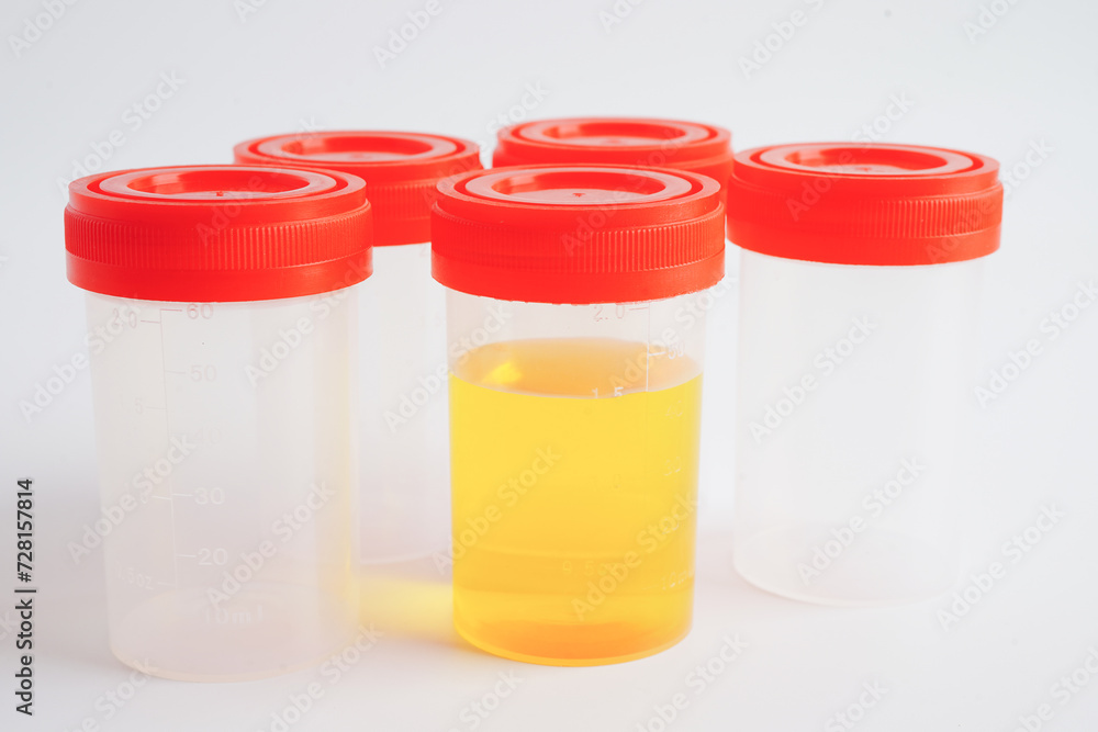 Urinalysis, urine cup for check health examination in laboratory. Urinalysis, urine cup for check health examination in laboratory.