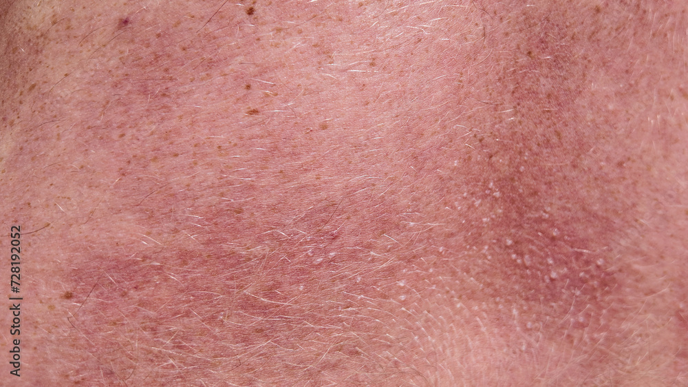 Close-up texture of human skin with fine hair and sun allergy with water bubbles, potentially useful for dermatological studies or skincare concepts