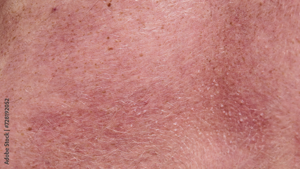 Close-up texture of human skin with fine hair and sun allergy with water bubbles, potentially useful for dermatological studies or skincare concepts Close-up texture of human skin with fine hair and sun allergy with water bubbles, potentially useful for dermatological studies or skincare concepts