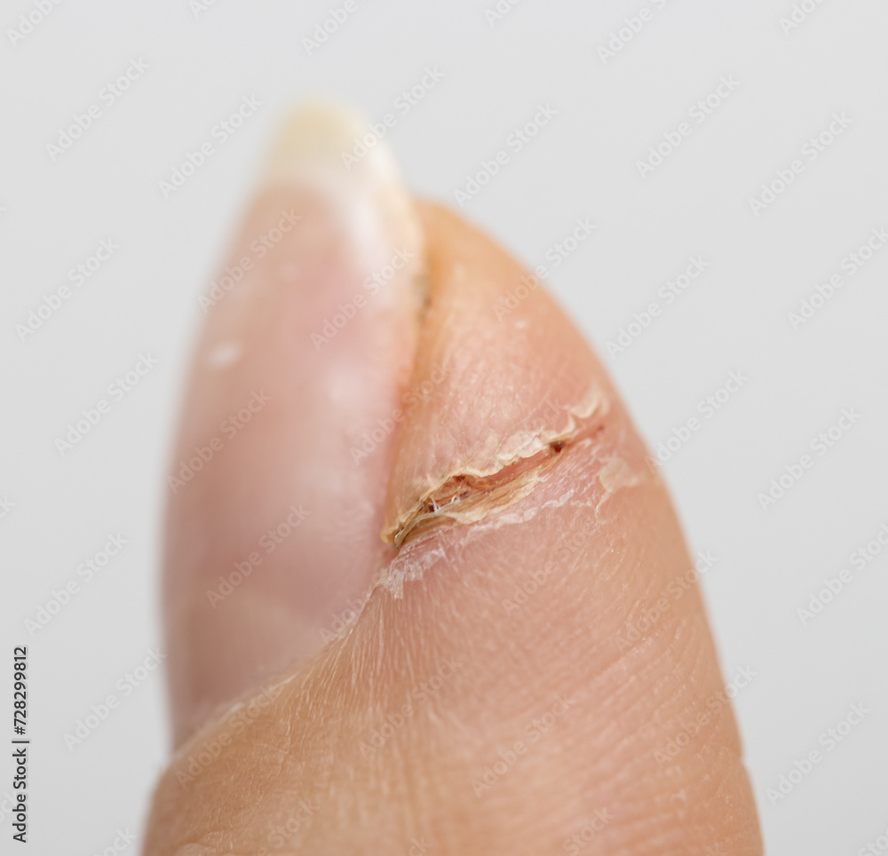 healed cut on a finger as a background. healed cut on a finger as a background.