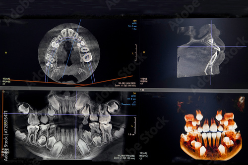 CT image of the teeth of a 9-year-old child, with baby teeth, in different projections. CBCT of two jaws. photo