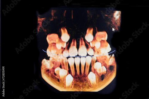 CT image of the teeth of a 9-year-old child, with baby teeth, in different projections. CBCT of two jaws.