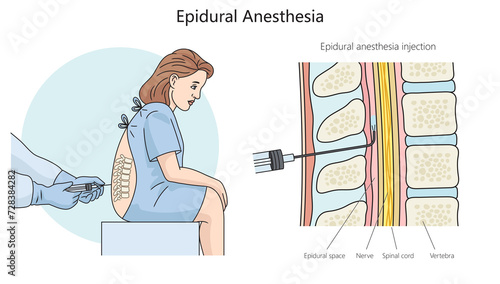 epidural anesthesia diagram hand drawn schematic raster illustration. Medical science educational illustration