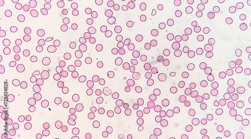 Suggestive of megaloblastic anemia to rule out Pernicious anemia (giant band, hyper segmented nucleus and myelocyte)., microscopic exam