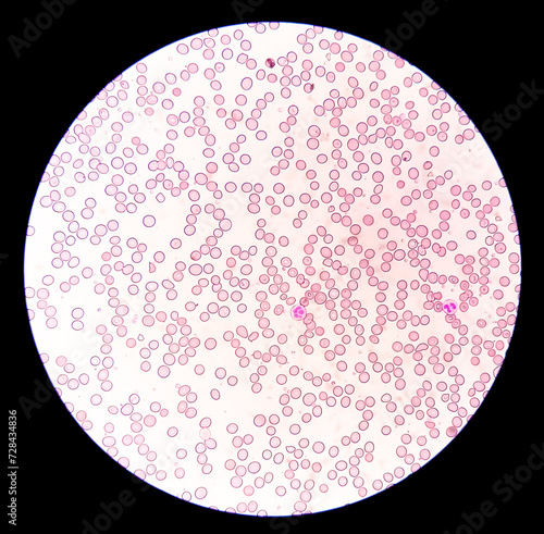 Suggestive of megaloblastic anemia to rule out Pernicious anemia (giant band, hyper segmented nucleus and myelocyte)., microscopic exam photo