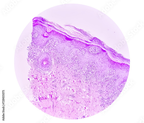 Photomicrograph of Skin tissue biopsy showing Lichen planus. T-cell mediated autoimmune disorder. photo