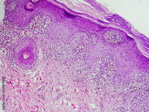 Photomicrograph of Skin tissue biopsy showing Lichen planus. T-cell mediated autoimmune disorder. photo