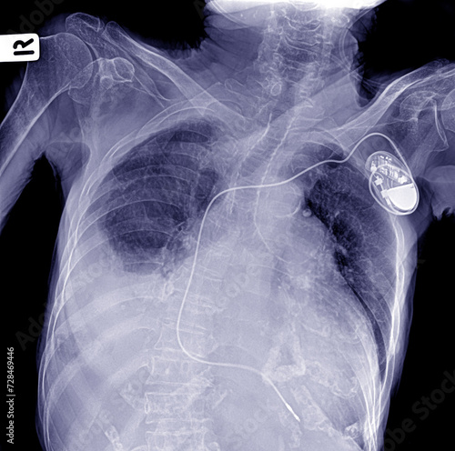defibrillator insertion to stimulate the heart rhythm
