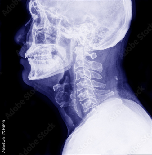 cervical x-ray images man with neck pain for a long time