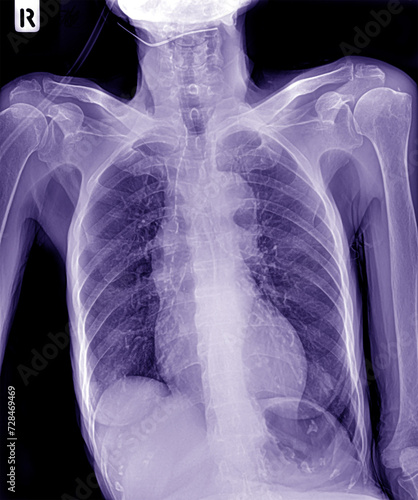 X-ray photographs of the chest, aging and thin due to enlarged heart disease