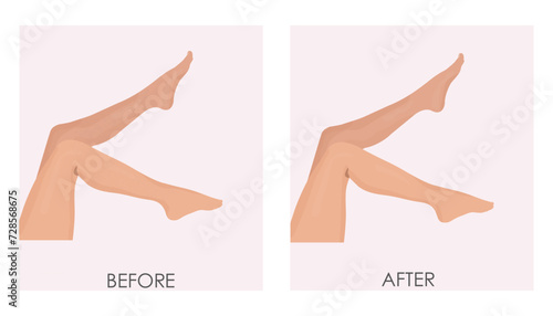 Vector illustration of before-after transformation. Hair removal on legs and shins. Laser hair removal, electrolysis or sugaring.