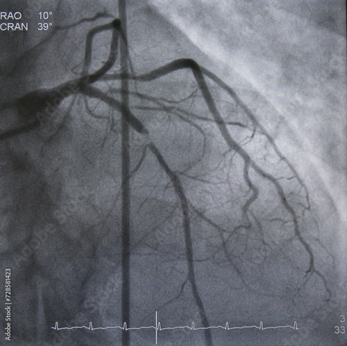 Coronary angiogram (CAG) was performed left anterior descending artery (LAD) stenosis.