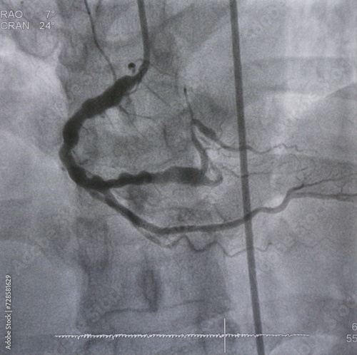 Coronary angiogram (CAG) was performed chronic total occlusion (CTO) at right coronary artery (RCA).