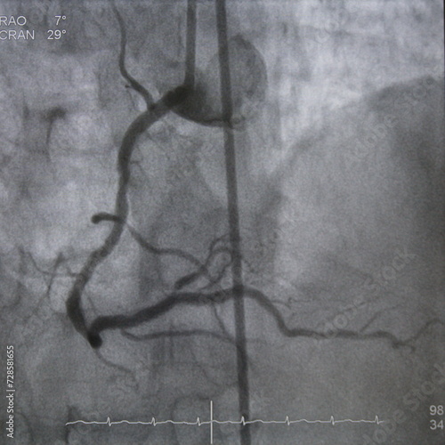 Coronary angiogram (CAG) was performed right coronary artery (RCA) stenosis. photo