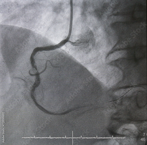 фотографія Coronary angiogram (CAG) was performed total occlusion at right coronary artery (RCA)