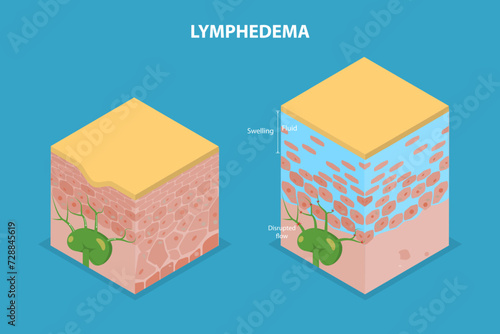 3D Isometric Flat Vector Illustration of Lymphedema, Disorder of Lymphatic System