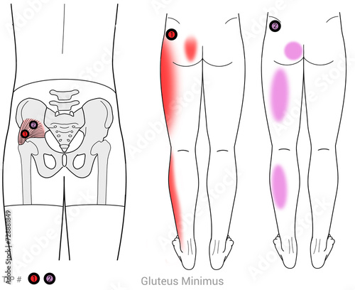 Gluteus Minimus: Myofascial trigger points and associated pain locations photo