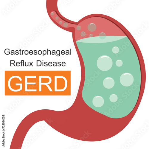 Gastroesophageal Reflux Disease (GERD) infographic.