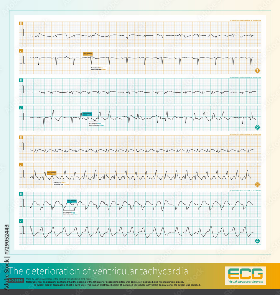 Male, 52 years old, diagnosed with acute extensive anterior myocardial infarction. The patient suffered recurrent ventricular tachycardia, worsened and died of cardiogenic shock. Male, 52 years old, diagnosed with acute extensive anterior myocardial infarction. The patient suffered recurrent ventricular tachycardia, worsened and died of cardiogenic shock.