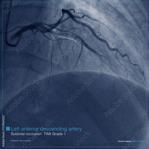 Male, 65 years old, admitted with chest pain for 2 hours. Coronary angiography indicates subtotal occlusion of the proximal to middle segment of the left anterior descending artery. photo