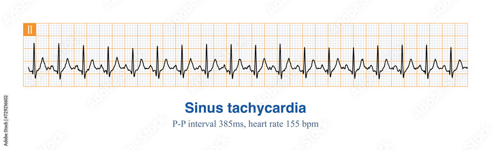 The frequency of sinus impulses exceeds 100 beats per minute, and the electrocardiogram diagnosis is sinus tachycardia. The important differential diagnosis is atrial tachycardia.