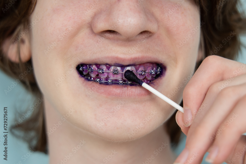 Plaque indicator on human teeth with braces. Plaque is colored pink ...