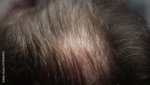Close-up top view of balding male head, brunette man with hair loss problem combs his head with black comb photo