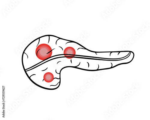 Vector isolated illustration of pancrea.Pancreatic pain. Pancreatic cancer.