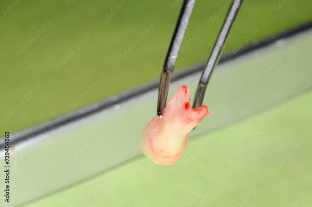 Fotografie lower second premolar with 3 roots