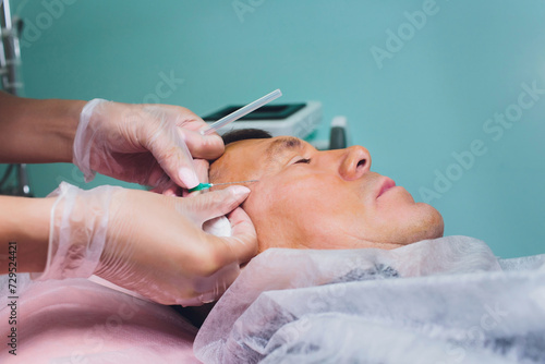 Close-up of procedure for face lifting PDO Suture operation, face lifting surgery. innovative technique of New thread lift, NovaThreads and Silhouette InstaLift men's bags under the eyes. photo