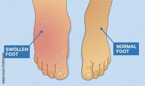Swollen foot, normal foot. Before, after. Healthcare illustration. Vector illustration. 