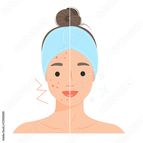 Сartoon woman with acne problem compare with woman with normal skin. Skin care procedure concept person. Vector design illustrations.